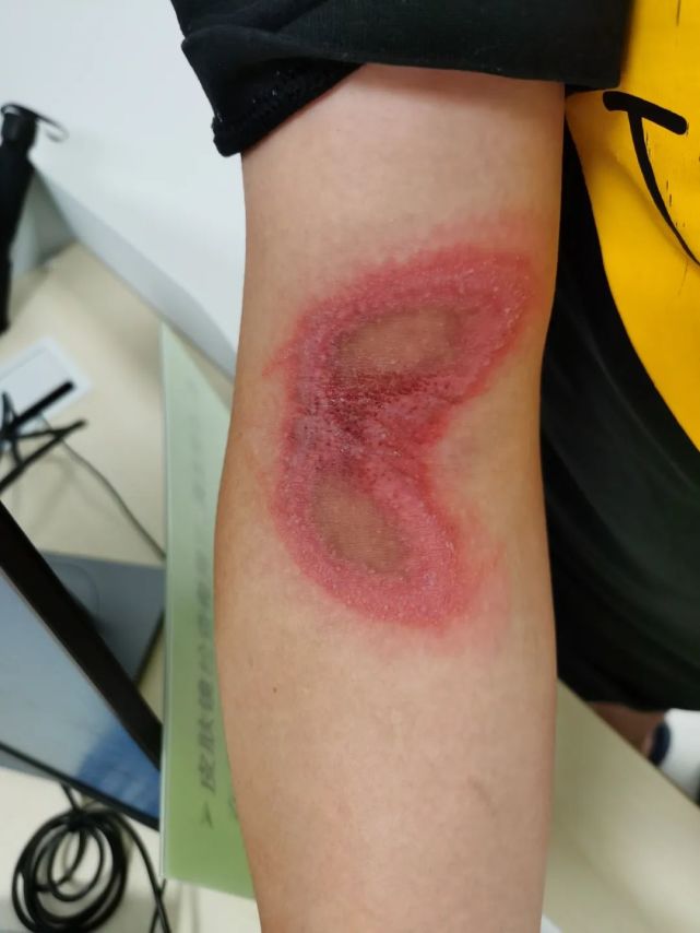 "你这是被隐翅虫咬了.