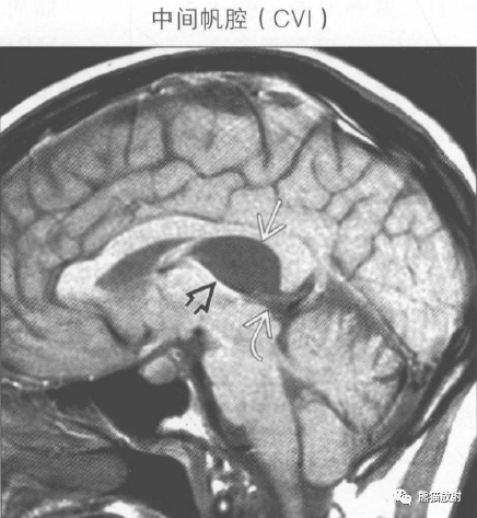 退化压迫脑底池第四脑室与其下方明显的脑脊液间隙相通小脑蚓正常存在