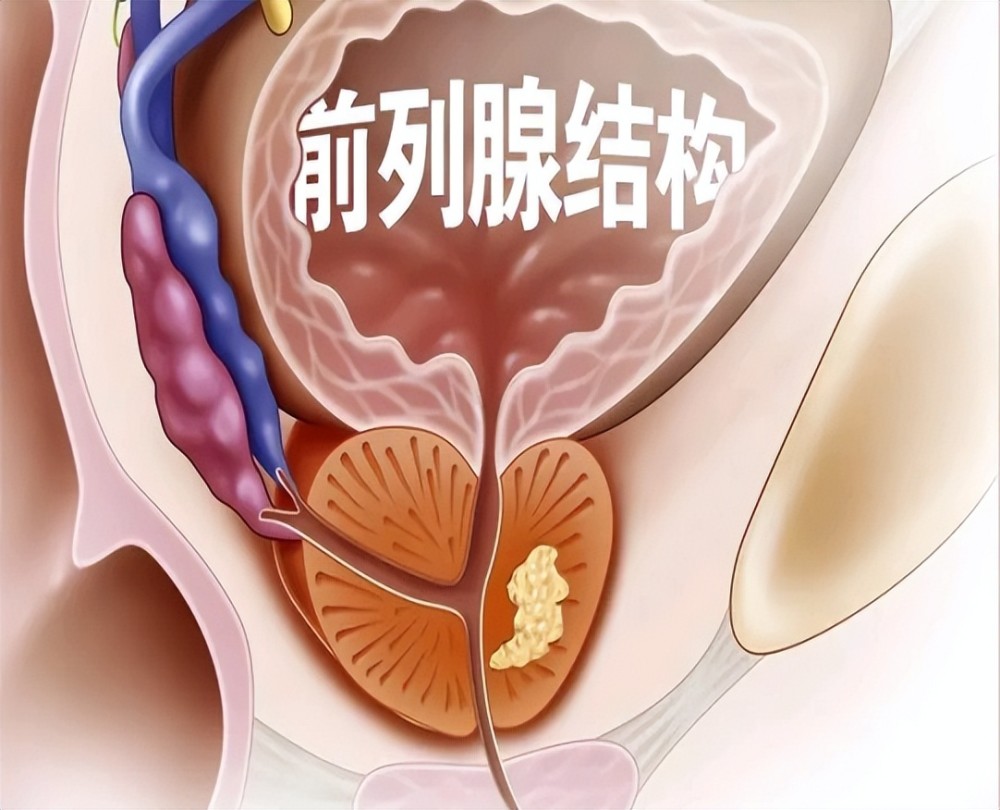 什么信号提示前列腺增生需要干预了本文告诉你