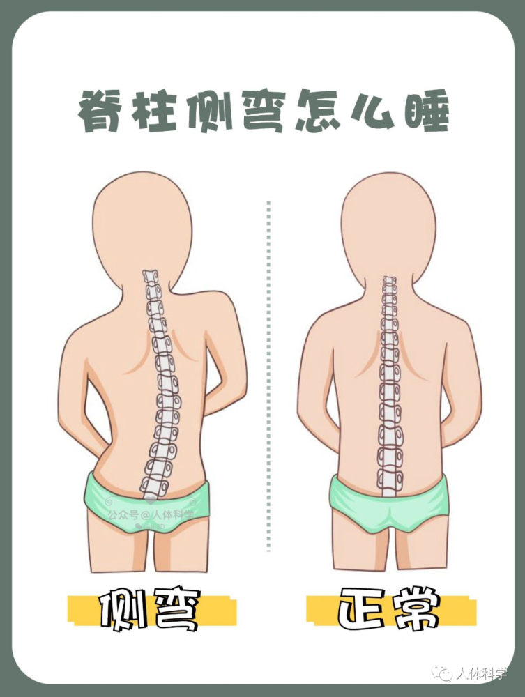 导致脊柱侧弯的原因之一—睡姿不当那应该怎么睡呢?