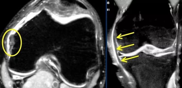 膝关节mri 肌腱韧带等