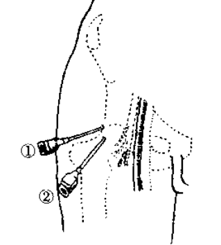 下与膝关节相通,故可在髌骨上方,股四头肌腱一侧,向内进针进入此囊(图