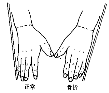 置一尺于小指及肱骨外髁,正常尺骨茎突不能接触此尺(图10).