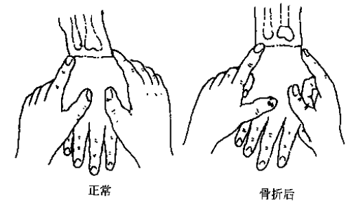 正常桡骨茎突位置较尺骨茎突远位,如桡骨远端骨折,二者可位于同一平面