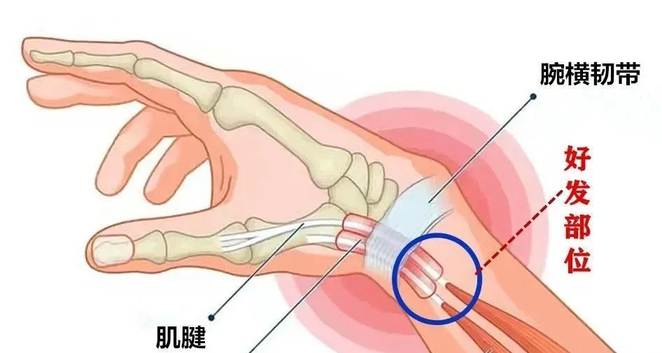 发生在手腕侧面处的腱鞘炎:常发生在各手指的掌指关节位置,即手指头的