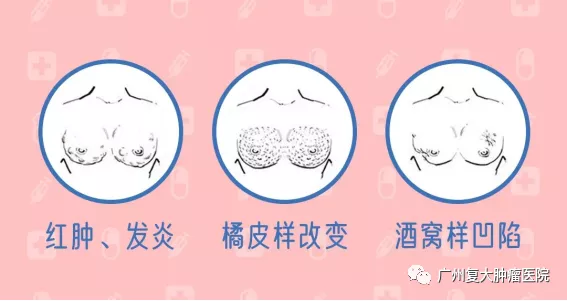 2,看乳房皮肤是否正常1,看乳房是否对称肿瘤会影响乳房的形状,所以