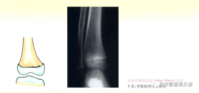 儿童骨骺损伤/骨折分型