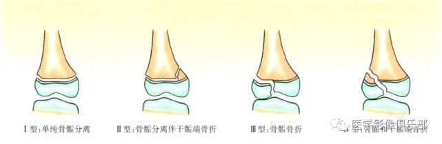 Ⅸ型:骨干骨折骨膜损伤生长塑形障碍.