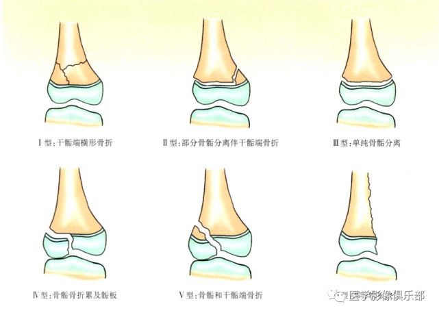 儿童骨骺损伤/骨折分型