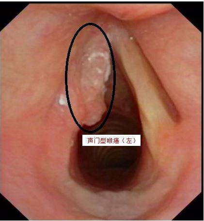 5,癌前病变  声带白斑是喉癌的癌前病变,它是指声带粘膜上皮角化不良