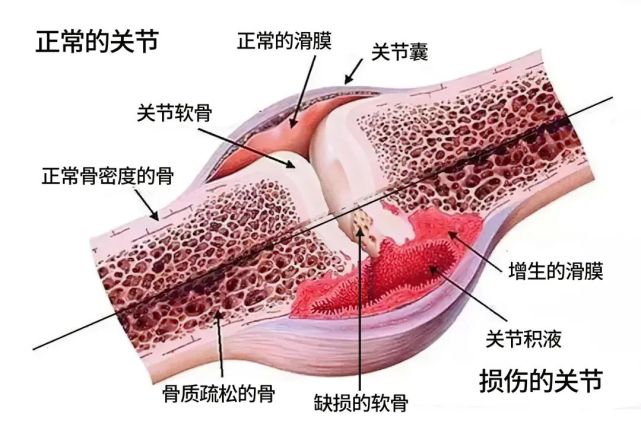 在骨性关节炎的关节内,增生的骨赘和关节腔内游离体,都可能损伤滑膜