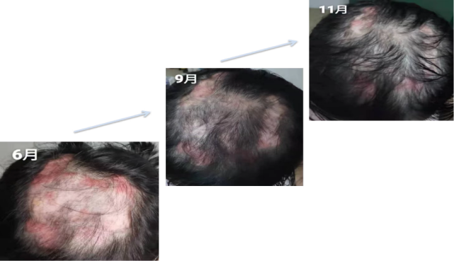 当出现脱发为首发症状时,尤其是年轻育龄女性,需要警惕合并红斑狼疮