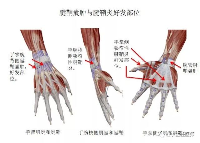 骨科精读|快速诊治"手腕部腱鞘囊肿",这几点很重要