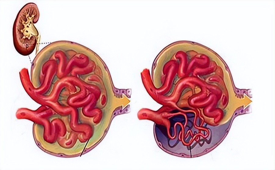 慢性肾衰竭症状表现多样化慢性肾衰竭到底该怎么治疗 腾讯新闻