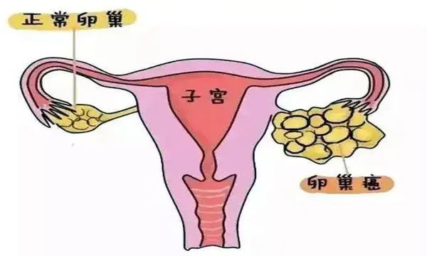 卵巢癌被称为"沉默的杀手"卵巢癌卵巢癌是女性生殖器官常见的恶性肿瘤