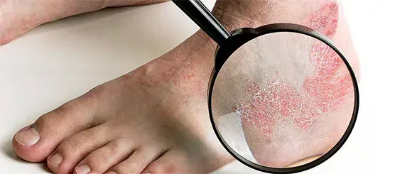 深圳肤康皮肤病专科银屑病为什么会有大量的皮屑