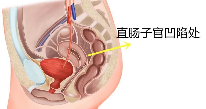 大部分女性都有"盆腔积液,当心越治越糟!_腾讯新闻