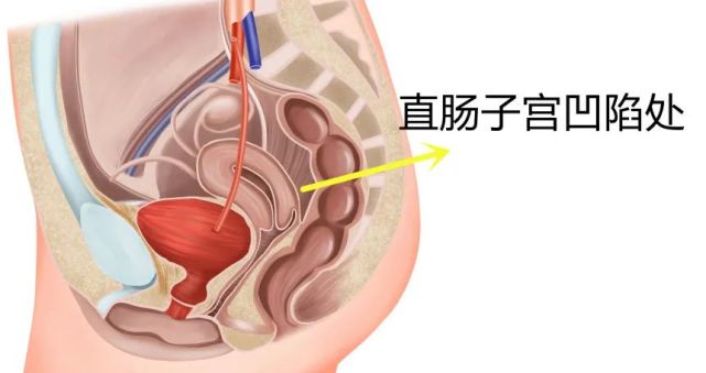 简单理解,盆腔积液的意思就是,有一些盆腔渗出性液体积聚在了子宫直肠