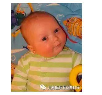 戒之馆婴亲霜分享宝宝先天性肌性斜颈的表现