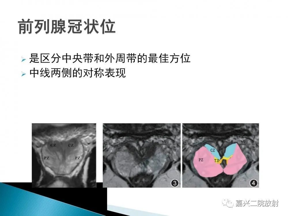 前列腺解剖分区及piradsv21版解读