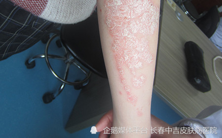 吉林银屑病医院:不同类型的牛皮癣分别会有哪些症状