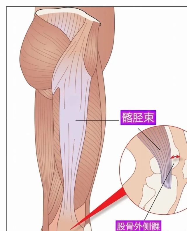 首先,得了解髂胫束长在我们身上的位置,它主要在大腿的外侧方,一端在