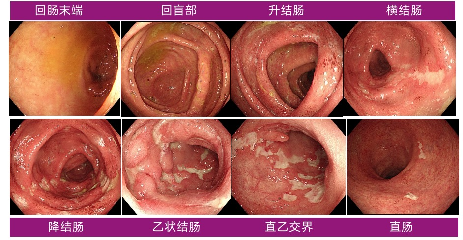 全结肠黏膜充血水肿糜烂,自横结肠至直肠见多发不规则溃疡,部分呈纵行