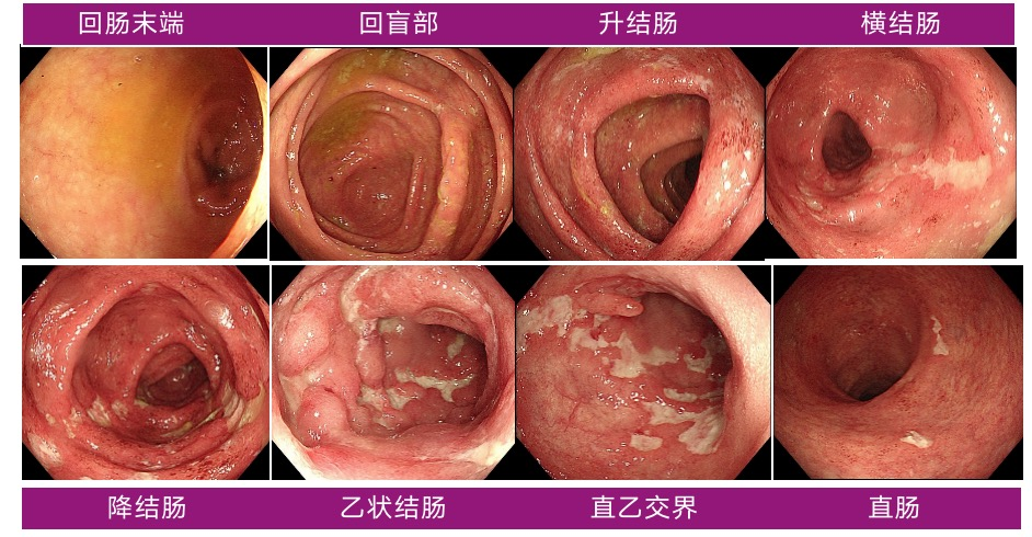 自横结肠至直肠见多发不规则溃疡,部分呈纵行,其中乙状结肠处