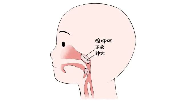 去儿童医院的耳鼻喉科检查,拍过片子之后,医生确诊大宝是腺样体肥大