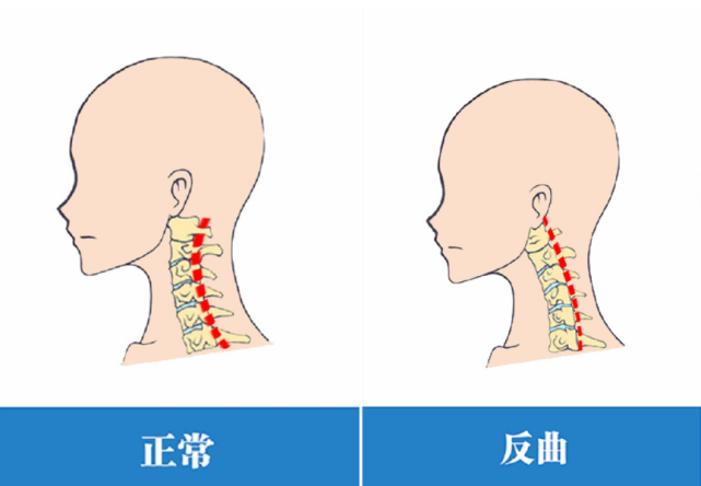 照镜子脖子夹纸怎么知道自己的颈椎有没有生理曲度变直或反曲