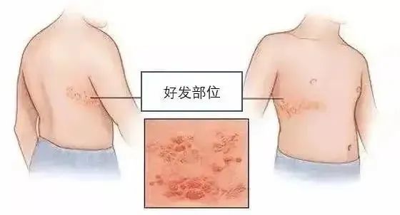 剧痛难忍!"缠腰龙","蛇盘疮"