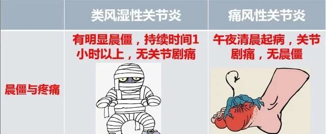 同为关节炎类风湿关节炎与痛风性关节炎之间有何不同