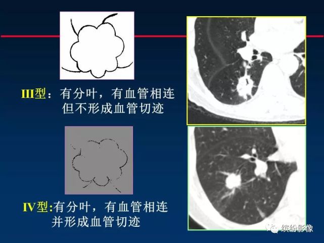 查阅资料,如下图,马教授等把血管集束征,分叶状,脐凹征三者结合起来