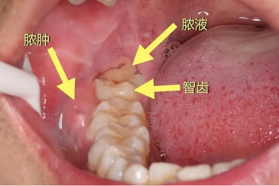 当代小青年关于"智齿"的疑惑