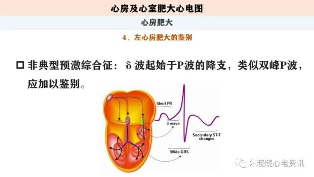 心电图解读第五讲:心房及心室肥大心电图(ppt)