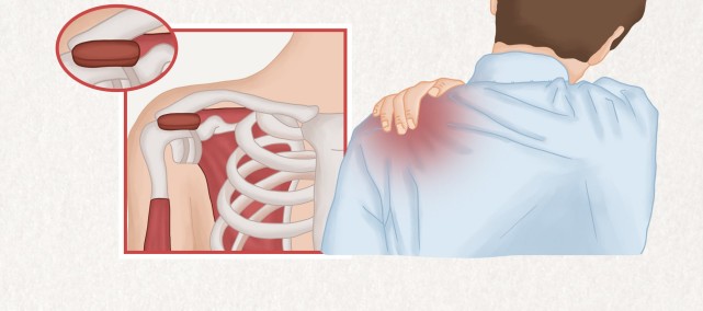 运动后肩膀痛,谨防肩袖损伤|肩袖撕裂|疼痛|肩周炎|肩关节|肩部