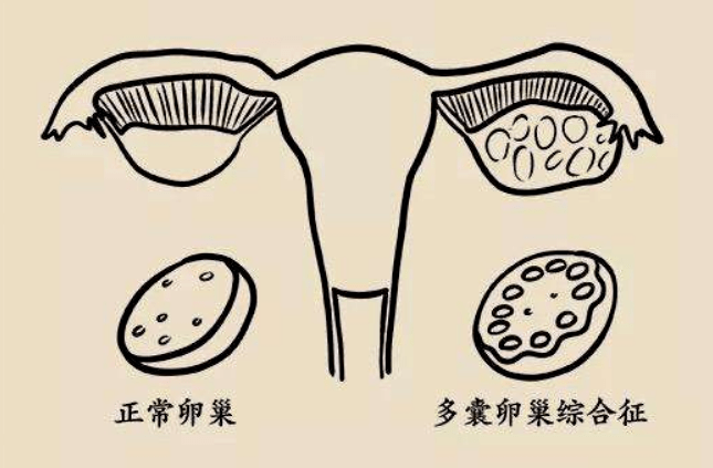 得了多囊卵巢综合征还能怀孕吗这个病要怎么治