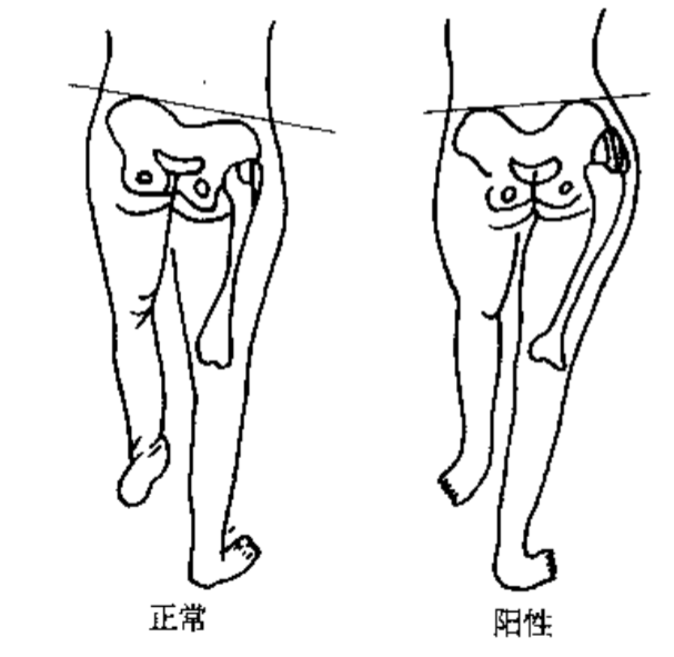 图27此阳性征可见于臀肌无力,先天髋脱位,髋内翻,股骨颈折不连.66.