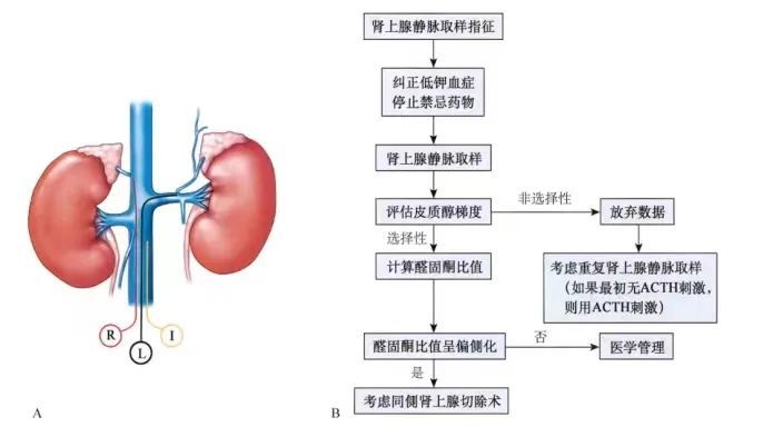 每日一学no101原发性醛固酮增多症的亚型与定位