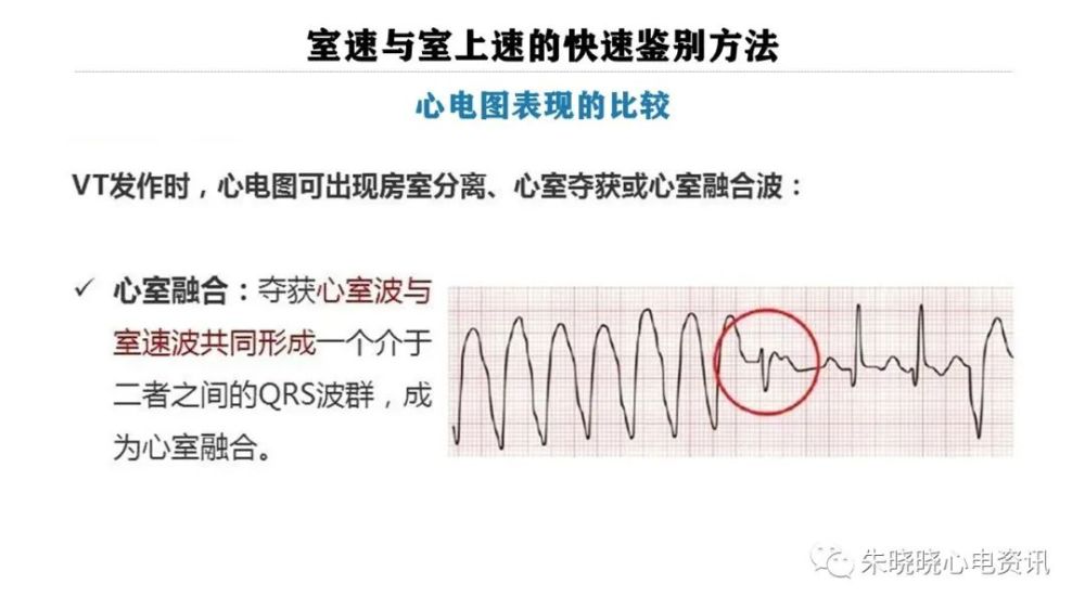 一看就会室速与室上速的快速鉴别方法ppt