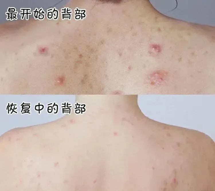这瓶沐浴露杀疯了螨虫痘痘痘印一洗就没皮肤嫩过水煮蛋