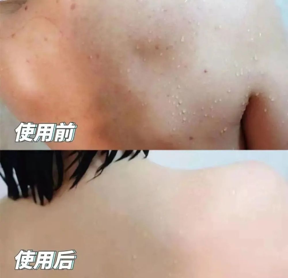这瓶沐浴露杀疯了螨虫痘痘痘印一洗就没皮肤嫩过水煮蛋