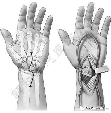 mayfield型腕关节损伤,同时还可用于桡骨远端骨折掌侧骨折块固定(图3)