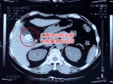 且在胆囊颈部和胆囊管交界处发现有多颗结石嵌顿