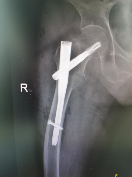 上图为术后x线,可见内固定物位置满意周世峰教授介绍,股骨粗隆间骨折