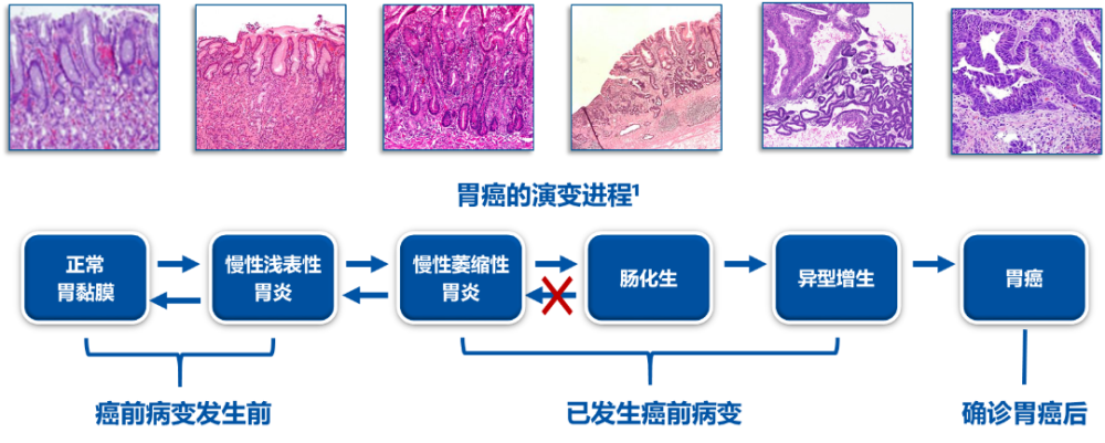 在胃癌进展的各个阶段,根除hp皆可阻断胃癌的演变进程12-17:hp感染