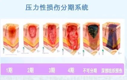 有以下分期:就已经是压疮1期了当皮肤出现压之不变白的红斑时「成都市