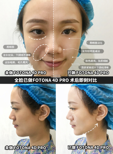 欧洲之星fotona4dpro和热玛吉哪种效果好欧洲之星fotona4dpro原理