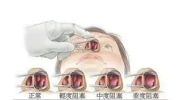 成都民生耳鼻喉医院鼻甲肥大治疗费用是多少国家三级医院