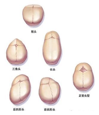 宝宝头型难看是睡姿问题这种疾病需要警惕